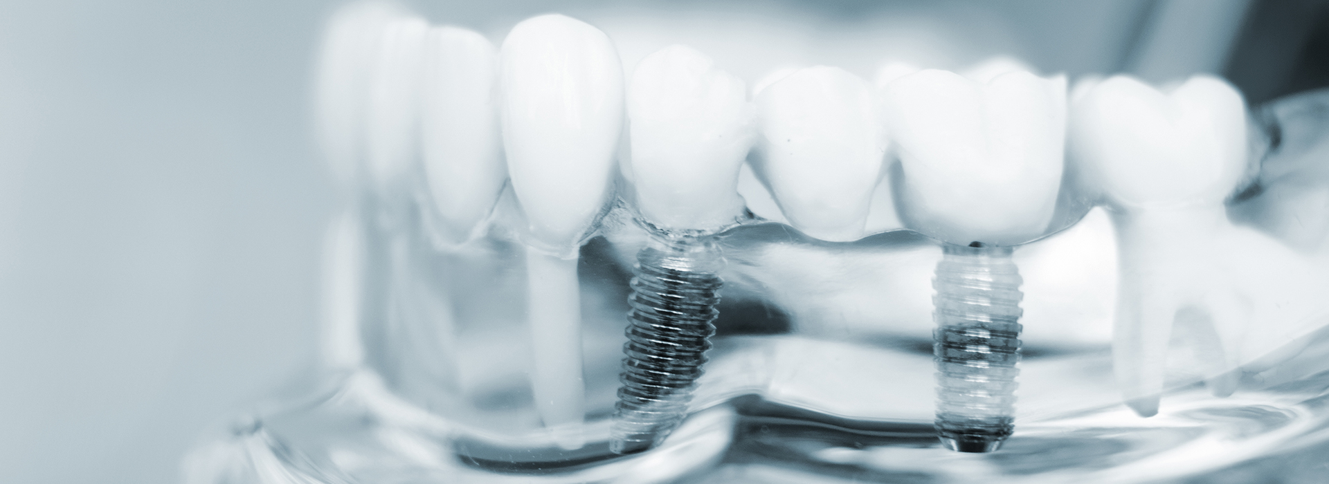 Crossroads Dental Group | CEREC, Dental Bridges and Extractions