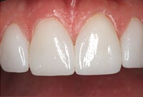 Crossroads Dental Group | Intraoral Camera, ZOOM  Whitening and CEREC