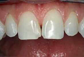 Crossroads Dental Group | Dental Bridges, Veneers and Preventative Program